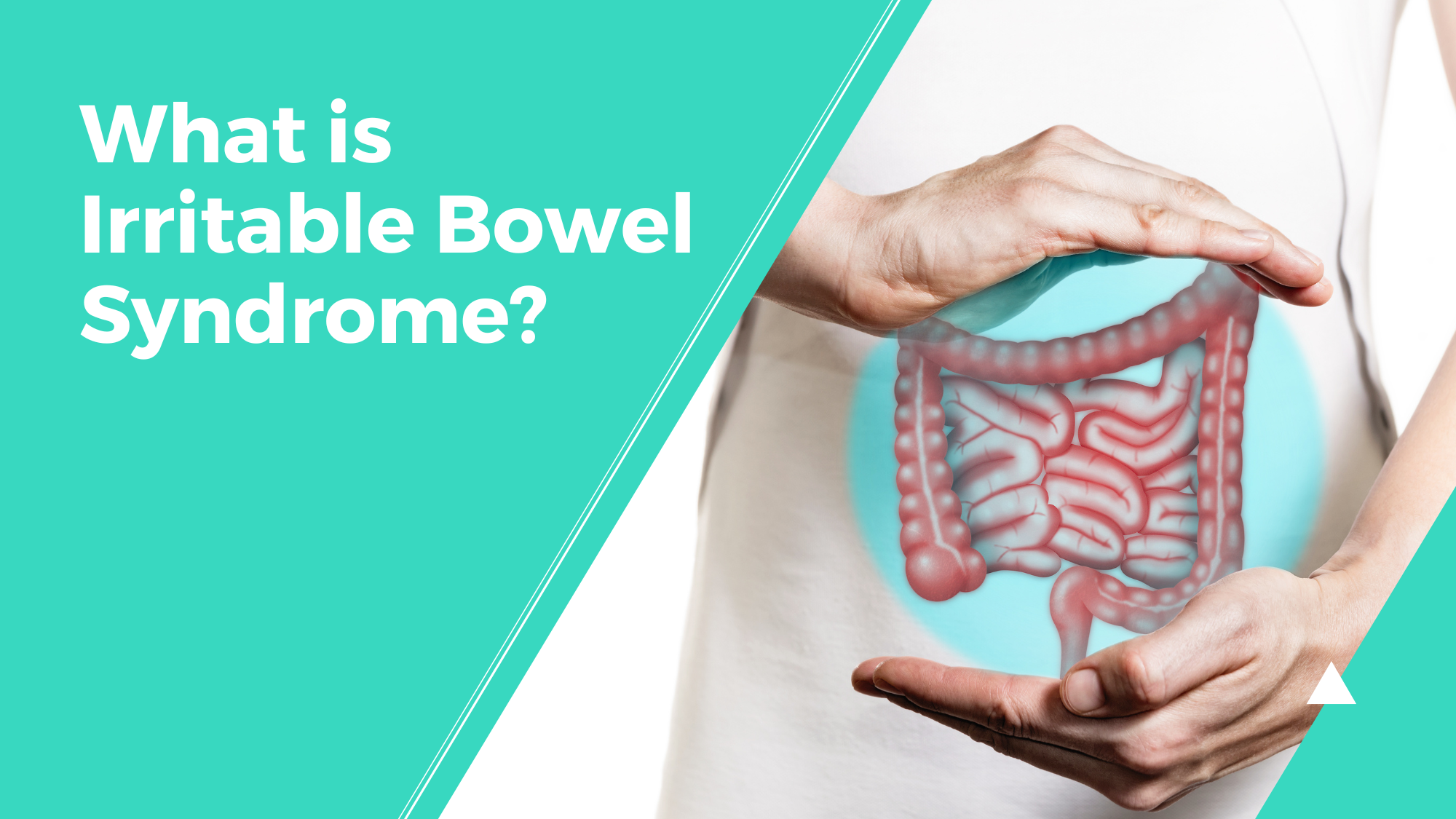 What Is Irritable Bowel Syndrome?